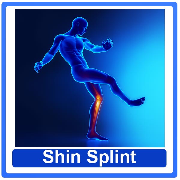 טיפול פיזיותרפיה לכאבי שוקיים בריצה- שין ספלינט- SHIN SPLINTS
